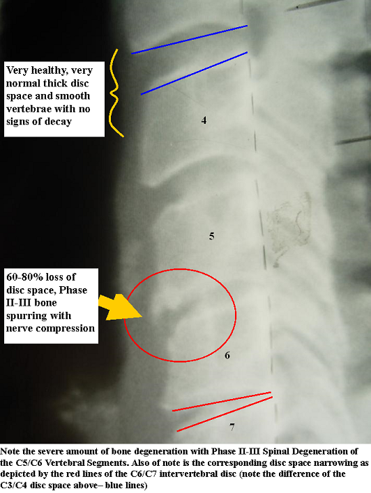 What are bone spurs in the neck?